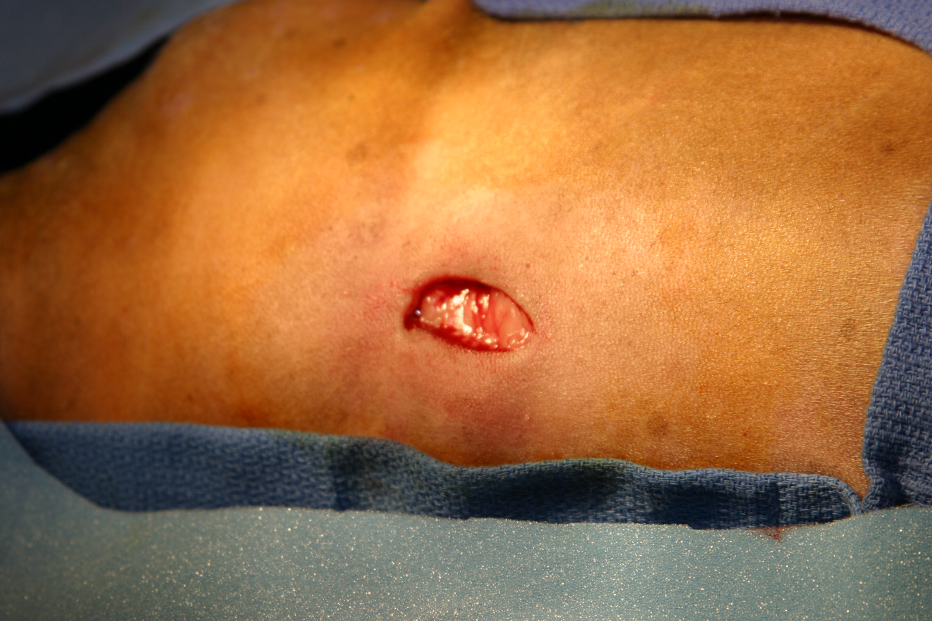 Pacemaker implantation image 5