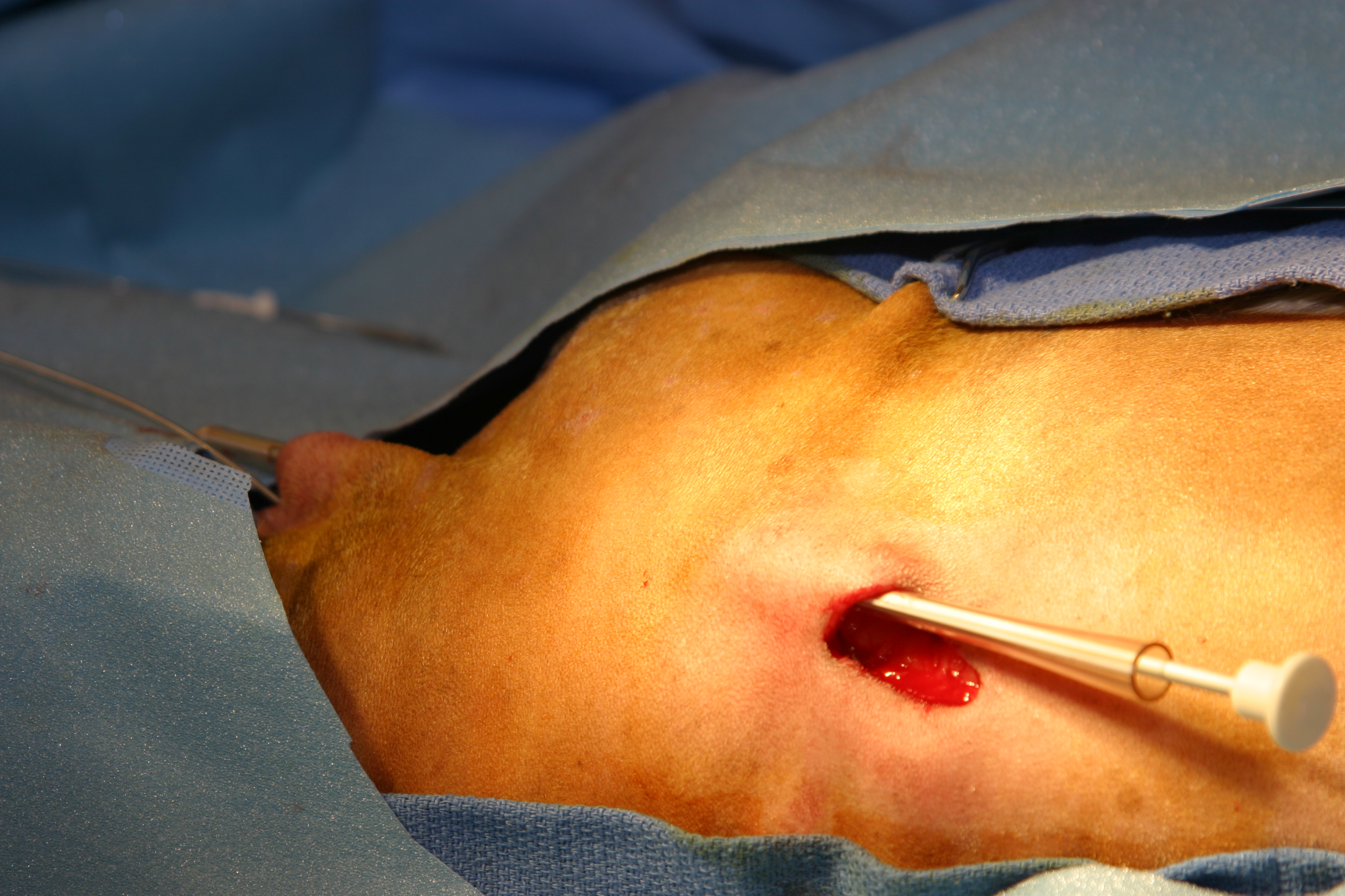 Pacemaker implantation image 6