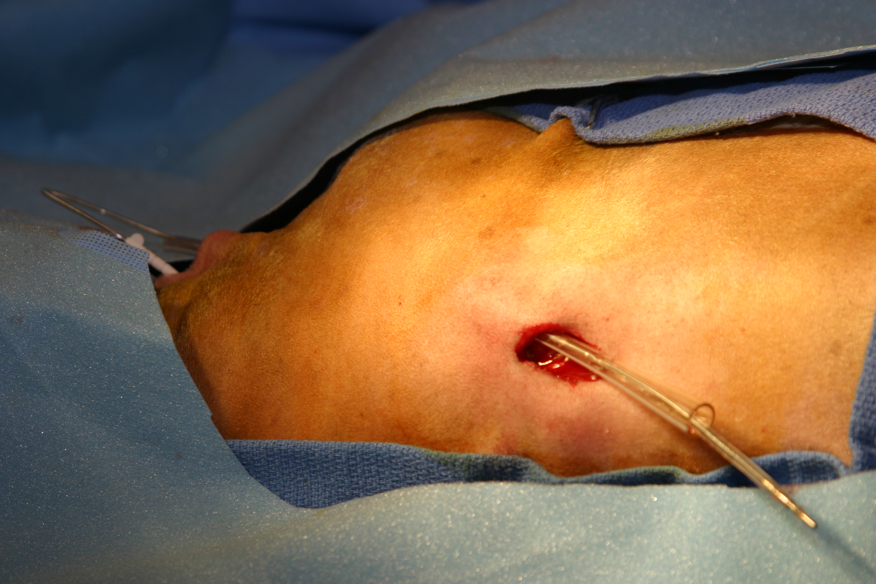 Pacemaker implantation image 7