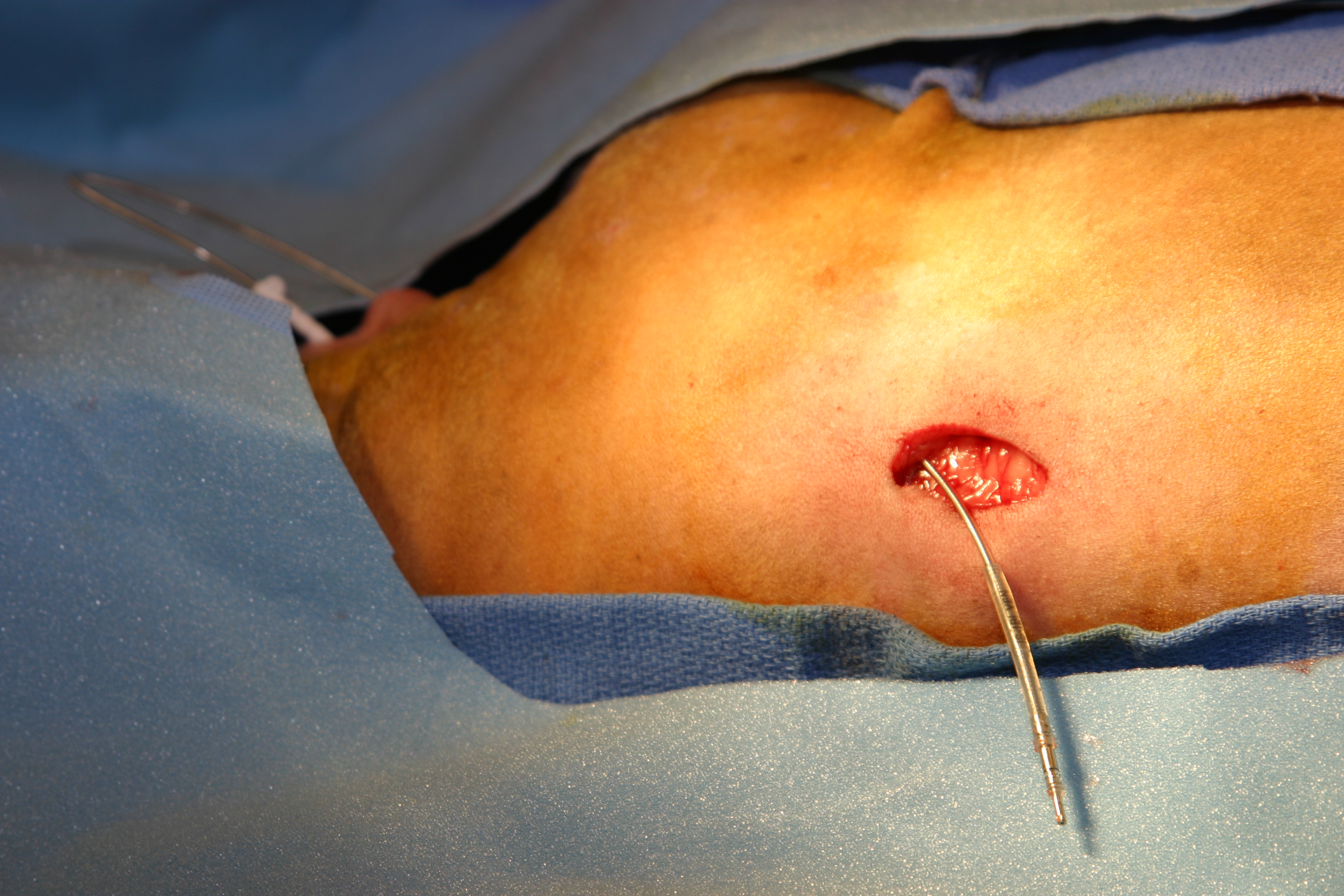 Pacemaker implantation image 8