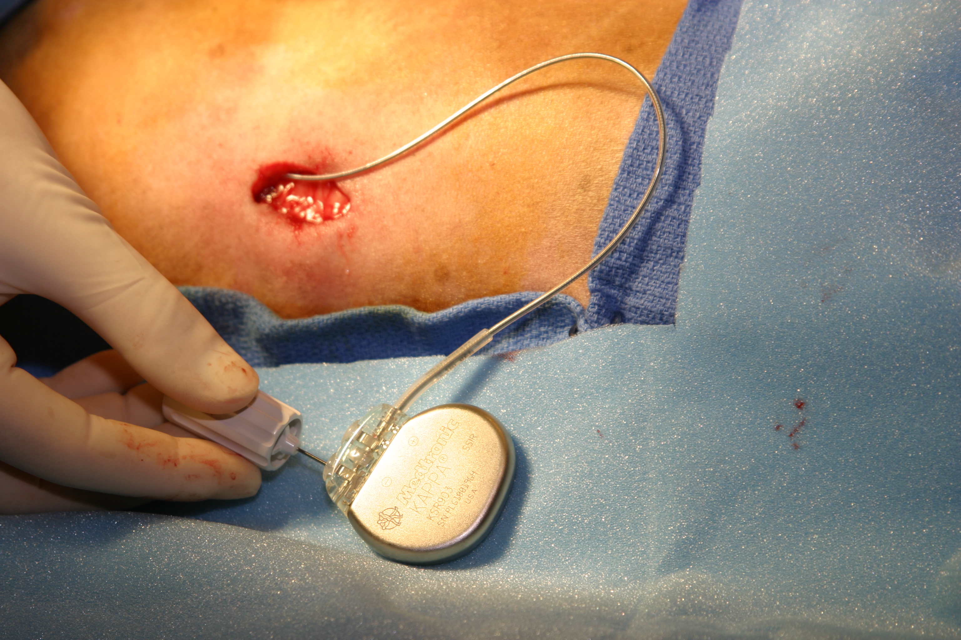 Pacemaker implantation image 9