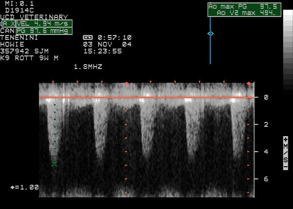 Continuous wave Doppler echocardiogram