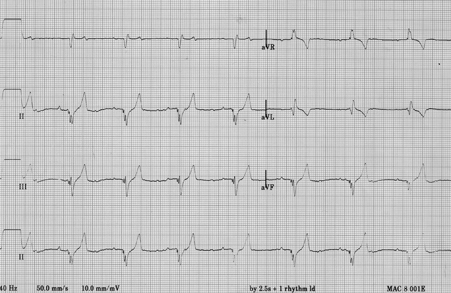 ECG tracing