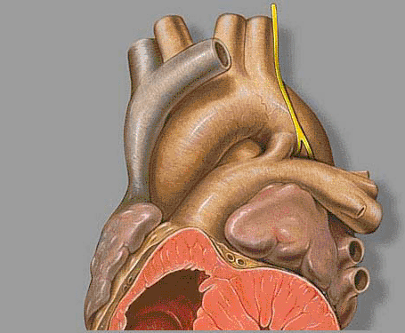 Diagram illustrating coil embolization of a PDA.