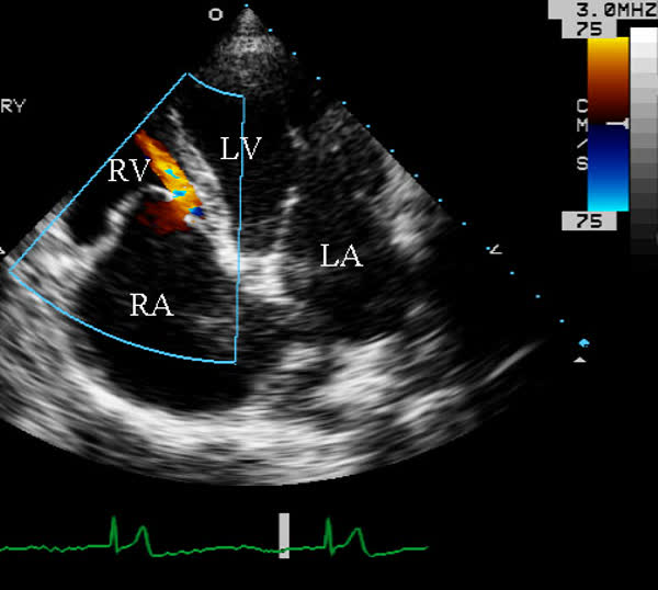 Color flow Doppler comparison case labeled