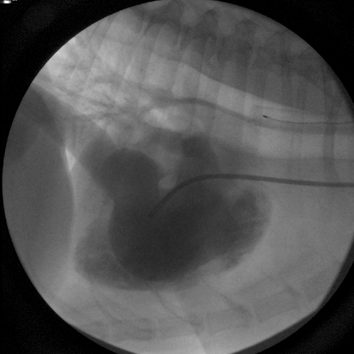 Angiogram frame - contrast in right atrium