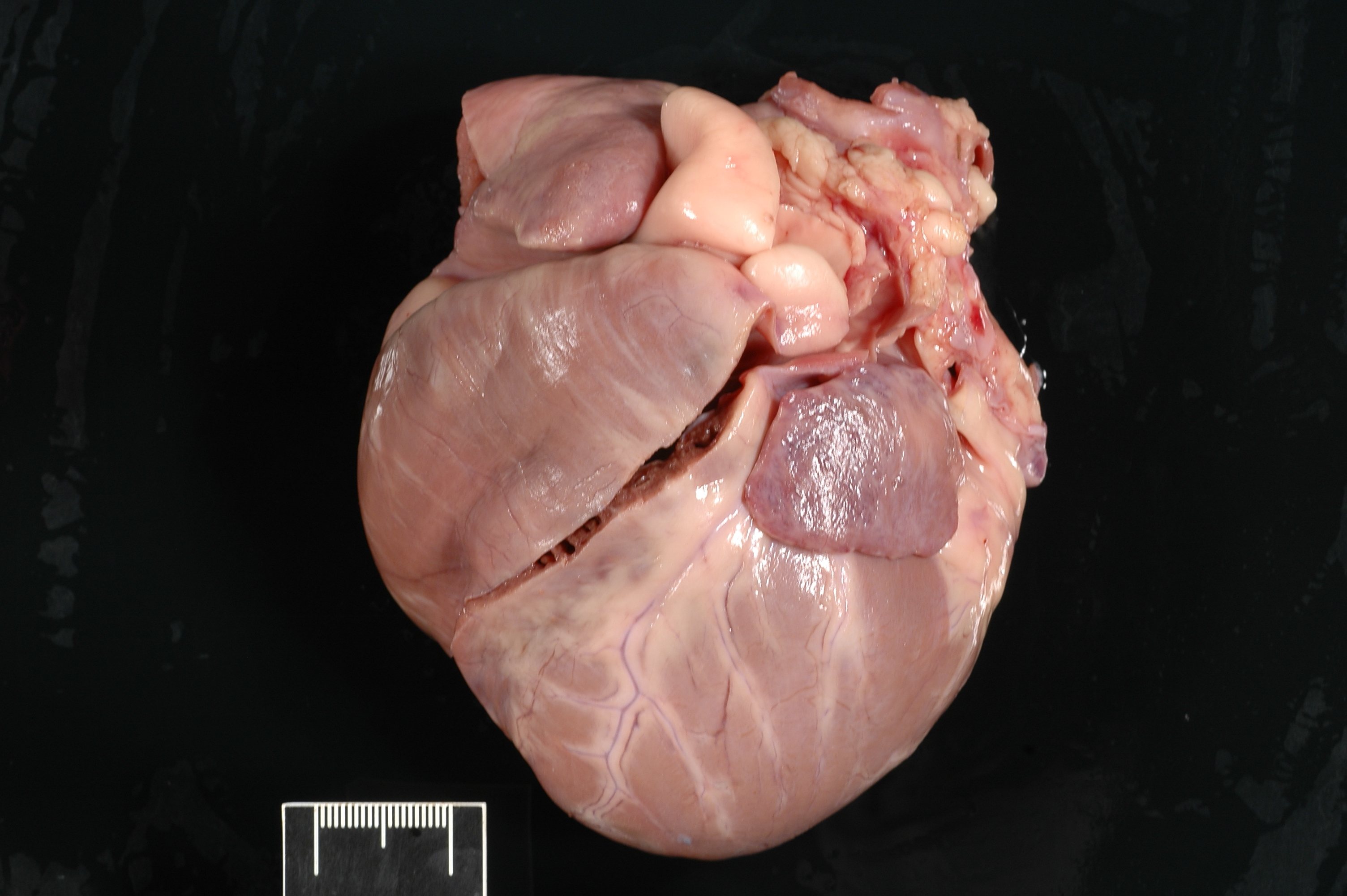 Sarah's heart - gross pathology