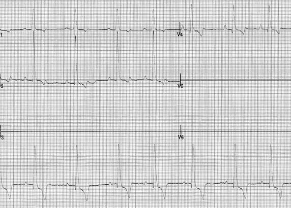 Second ECG trace providing the six limb leads and chest leads. The R wave in V2 (CV6LL) exceeds 3 mV, further supporting left ventricular hypertrophy. Sinus rhythm is present.