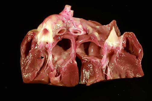 Longitudinal section through the left atrium, mitral valve, and aorta. An arrow points to the narrowed left ventricular outflow tract between the basilar region of the interventricular septum and the anterior leaflet of the mitral valve. The outflow tract leads into the aorta. The enlarged left atrium lies above the mitral valve.