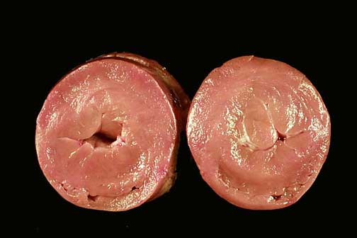 Cross-sectional view primarily of the left ventricle in rigor (post-mortem contracture). The left ventricular cavity is almost obliterated (end-systolic cavity obliteration). The papillary muscles in the cross-section on the right are extremely enlarged.