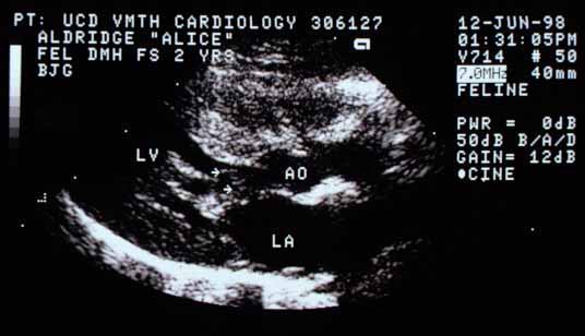 Right parasternal longitudinal view of the left ventricle (LV), left atrium (LA), and aorta (AO) in systole. Arrows indicate the anterior mitral valve leaflet and chordal structures partially obstructing the left ventricular outflow tract — systolic anterior motion (SAM) of the mitral valve.
