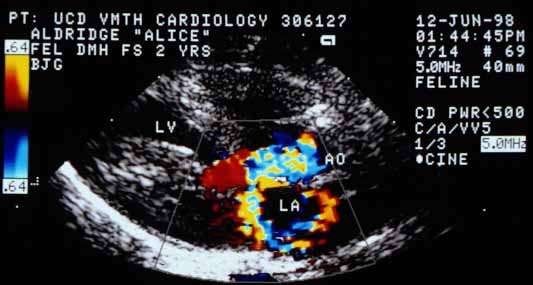 Color flow Doppler in the same longitudinal orientation as above. Two turbulent high-velocity jets originate from the same site in the left ventricular outflow tract during systole: one projects into the aorta (AO) and a second projects back into the left atrium (LA), consistent with SAM-related dynamic obstruction and secondary mitral regurgitation.