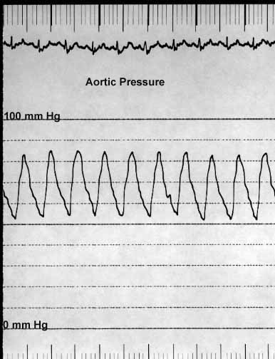 Pressure tracing recorded from the aorta showing systolic and diastolic waveforms. Systolic pressure is elevated and matches pressures recorded from other structures.