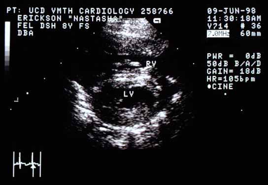 Right parasternal cross-sectional echocardiographic view (90-degree rotation from the long-axis view). The left ventricular chamber (LV) is again small. The right ventricular free wall (RV) appears markedly thickened.