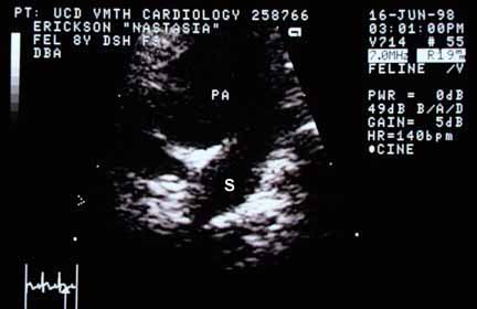 Echocardiogram from the right side showing a very large pulmonary artery (PA) with a structure (S) opening into it. The structure appears as a large rounded communication between the PA and an adjacent vessel.