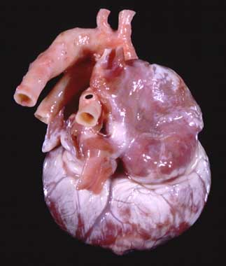 Post-mortem photograph of Nastasia's heart viewed from above, behind, and to the right, showing the markedly enlarged right atrium and extensive fibrosis of the ventricular myocardium.