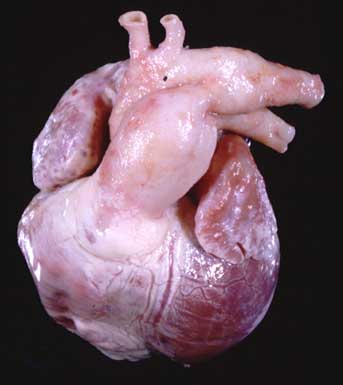 Post-mortem photograph of Nastasia's heart viewed from in front and to the right, showing the markedly enlarged main pulmonary artery (MPA). The ductus can be seen connecting the MPA to the descending aorta.