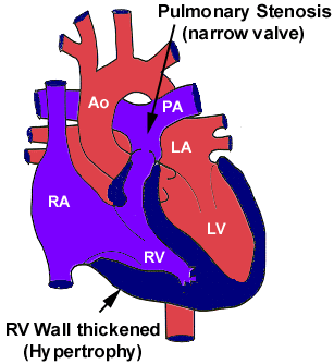 Diagram illustrating the anatomy of pulmonic stenosis, showing the narrowed pulmonic valve and the thickened right ventricular wall.