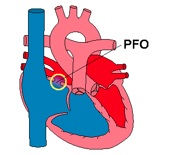 Labeled diagram of the heart showing the atrial septal defect (patent foramen ovale) with arrows indicating right-to-left shunting across the defect.