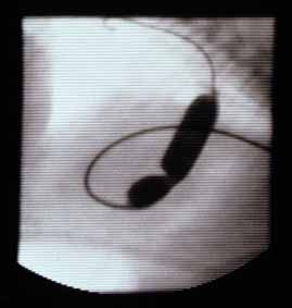 Fluoroscopic image of the partially inflated balloon catheter showing an indentation at the site of the stenotic pulmonic valve.
