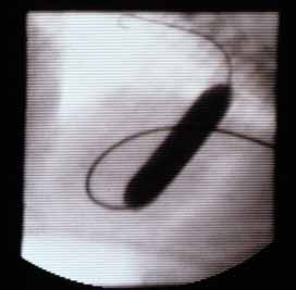 Fluoroscopic image of the fully inflated balloon catheter. The indentation has disappeared, indicating the stenotic valve has been opened.