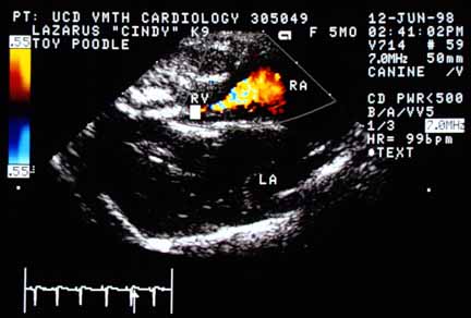 Color flow Doppler image taken in systole from the tricuspid valve region. A high-velocity turbulent jet originates at the tricuspid valve and extends back into the right atrium (RA). The jet is turbulent at its origin and for about one centimeter into the right atrium, then broadens and loses momentum as it dissipates.