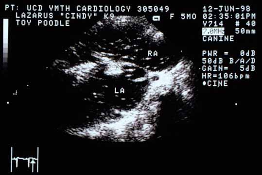 Right parasternal echocardiogram taken immediately after agitated saline injection into a peripheral vein. Microbubbles appear as white dots and lines in the right atrium (RA). They are also visible within the defect in the atrial septum and in the left atrium (LA), indicating a right-to-left shunt at the atrial level.