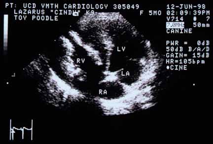 Four-chamber echocardiographic view from the left apical position showing an extremely thickened right ventricular free wall (to the left of the RV label). The subendocardium of the right ventricle is severely hyperechoic, suggesting damage and fibrosis. RV — right ventricular chamber; LV — left ventricular chamber; RA — right atrial chamber; LA — left atrial chamber.