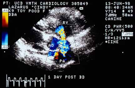 Color flow Doppler after valvuloplasty. The signal does not show laminar flow but is primarily due to aliasing rather than turbulence. The signal is much wider at the pulmonic valve than before valvuloplasty. RV — right ventricular cavity; AO — aorta; PA — main pulmonary artery.