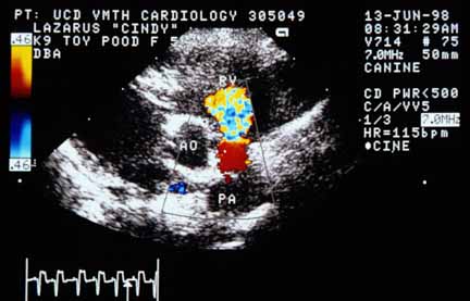 Color flow Doppler in diastole demonstrating pulmonic regurgitation after valvuloplasty. Laminar flow in the pulmonary artery (PA) comes toward the transducer (red), aliases at the pulmonic valve region, and projects into the right ventricle (RV). The jet appears larger than before valvuloplasty but is hemodynamically insignificant due to the low pressure gradient.