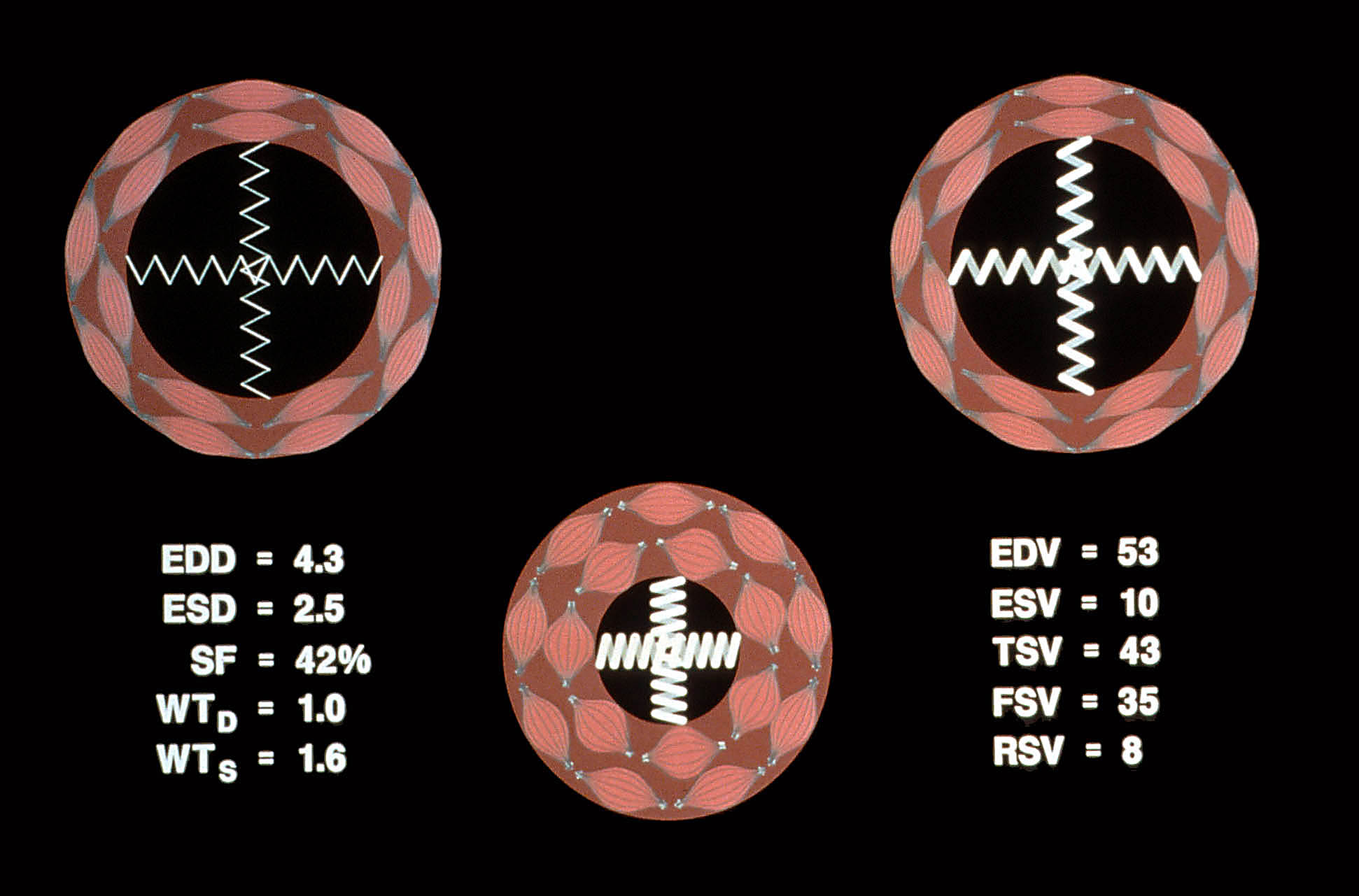 Mild mitral regurgitation with increased contractility schematic